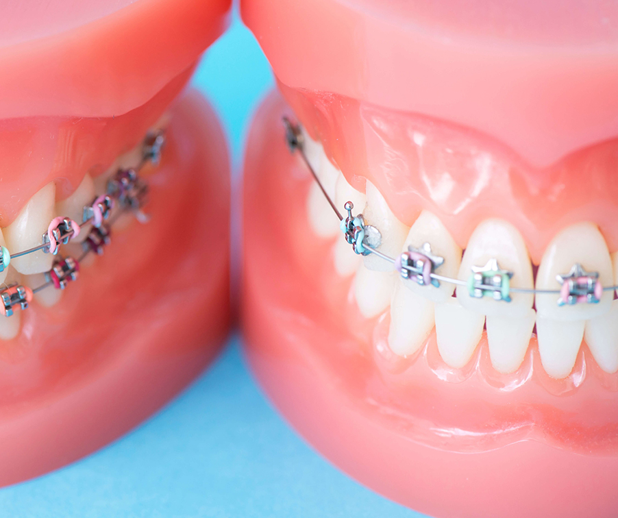 矯正治療はいつから始めたらよいですか？