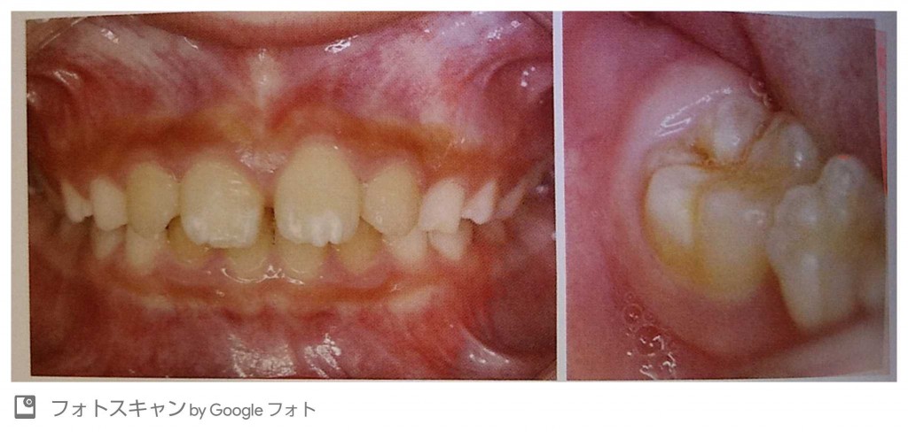 最近の子供の虫歯 名古屋市瑞穂区の歯科医院 ましろデンタルクリニック